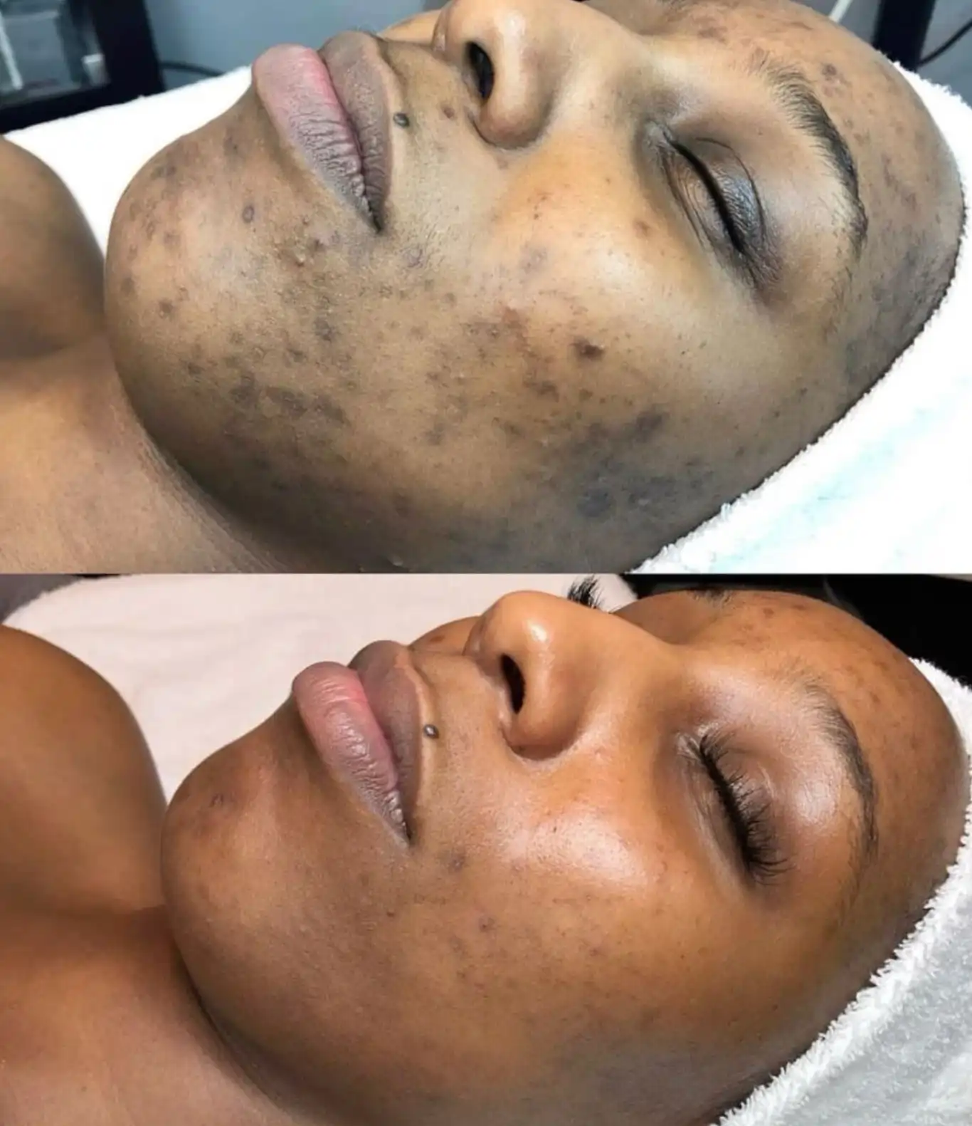Dark-Spot-Removal