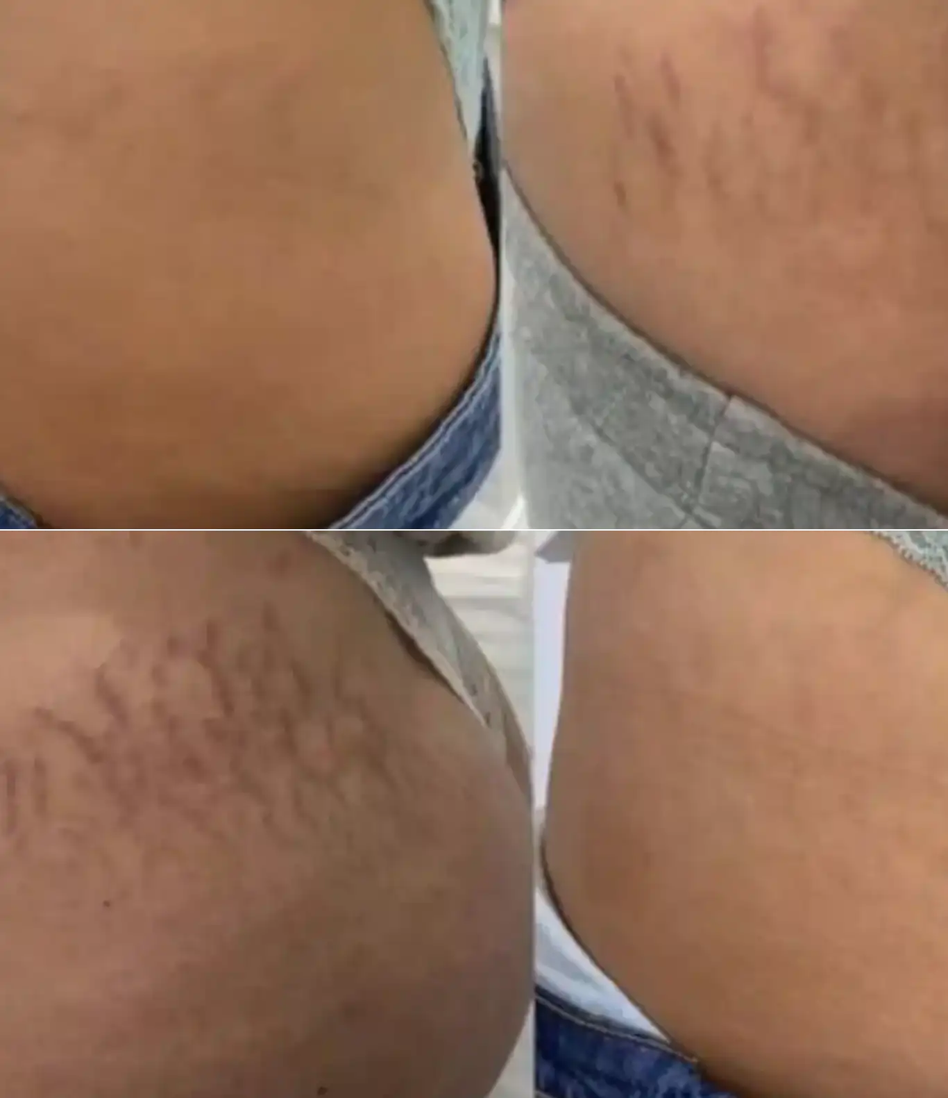 Stretchmark-Removal