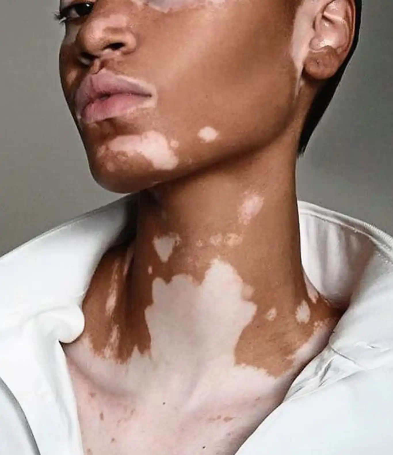 vitiligo