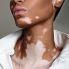 vitiligo